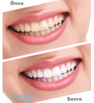 ultradent opalescence go 8 li dis beyazlatma hazir kalip