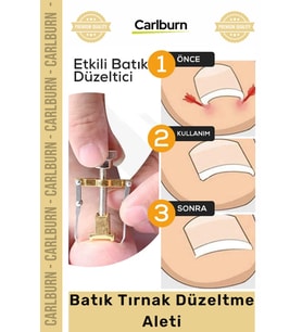 Özel Üretim Ayak Tırnağı Batma Ağrısı Giderici Evde Güvenli Kolay Bakım Batık Tırnak Düzeltici