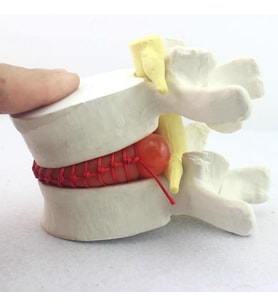 Disk Hernisi Fıtık Maketi Model 2