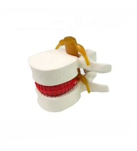 Disk Hernisi Fıtık Maketi Model 2