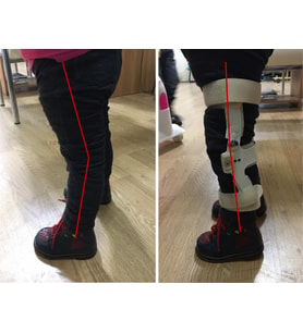 Karma Grup Ortopedi Genu Rekurvatum Dizlik İsveç Diz Ortezi BÜKÜLEBİLİR.(3XL BEDEN - - DİZ ÇEVRE ÖLÇÜSÜ 50-56 CM YETİŞKİN BEDENİ)