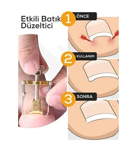 Batık Tırnak Çıkartıcı Orijinal Çelik Batan Tırnağı Düzeltme Aparatı Düzeltici Aleti Çıkarıcı Aparat
