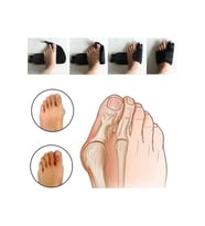 Halluks Valgus Ayak Başparmak Düzeltici Gece Ateli Ortopedik Kemik Çıkık Çıkıntısı Ateli (Siyah)