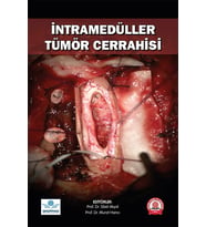 İntramedüller Tümör Cerrahisi