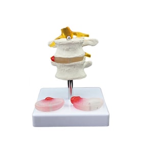 Lumbar Vertebra Disk Hernisi Omurga Modeli Model 4
