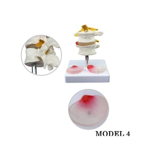 Lumbar Vertebra Disk Hernisi Omurga Modeli Model 4
